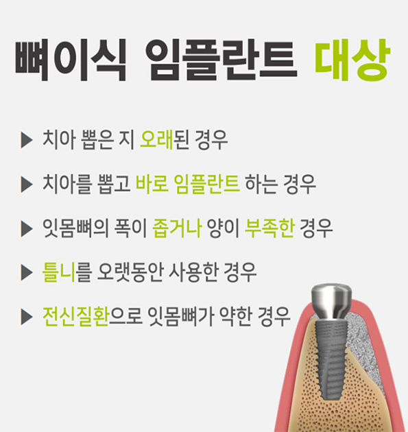 뼈이식 임플란트