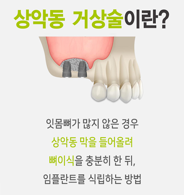 상악동 거상술